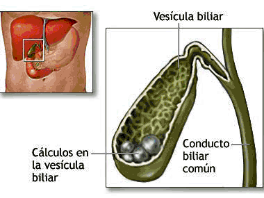 Cetosis vesícula biliar