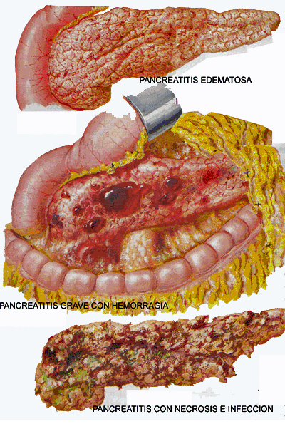 Pancreatitis Aguda