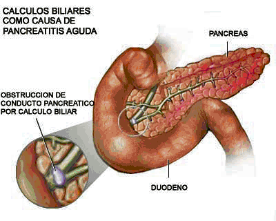 Pancreatitis Aguda